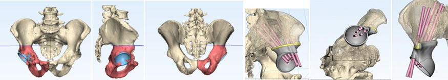 3D modelling of pelvic bone excision with one-stage endoprosthesis replacement