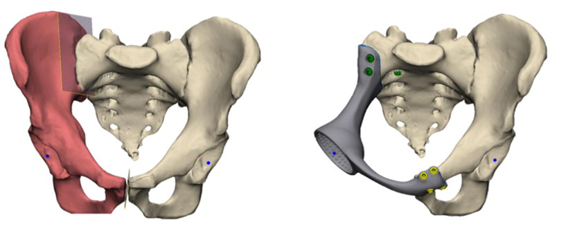 3D моделирование резекции костей таза с одномоментным эндопротезированием