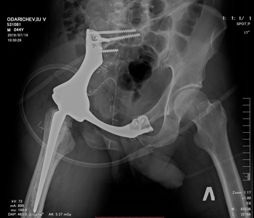X-ray after pelvic bone excision with one-stage endoprosthesis replacement