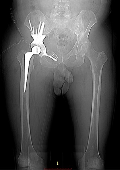 X-ray after pelvic bone excision with one-stage endoprosthesis replacement