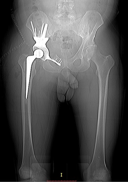 Рентгенограмма после резекции и эндопротезирования таза