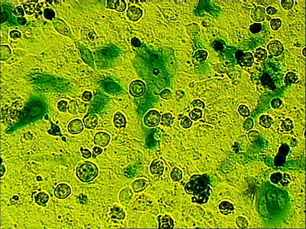 Доказана высокая эффективность геномодифицированной противоопухолевой вакцины при меланоме кожи и раке почки