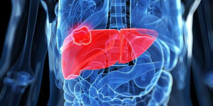 Метастазы в печени: симптомы и прогноз