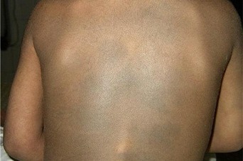 невус Сеттона