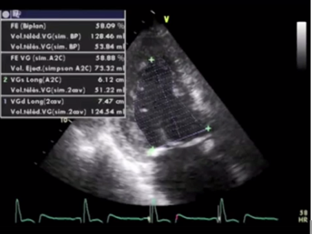 Измерение ФВ ЛЖ в 2D режиме по Simpson
