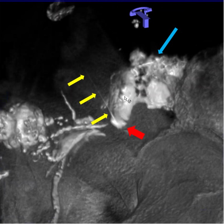 Интранодальная паховая ПДКТ-лимфангиография