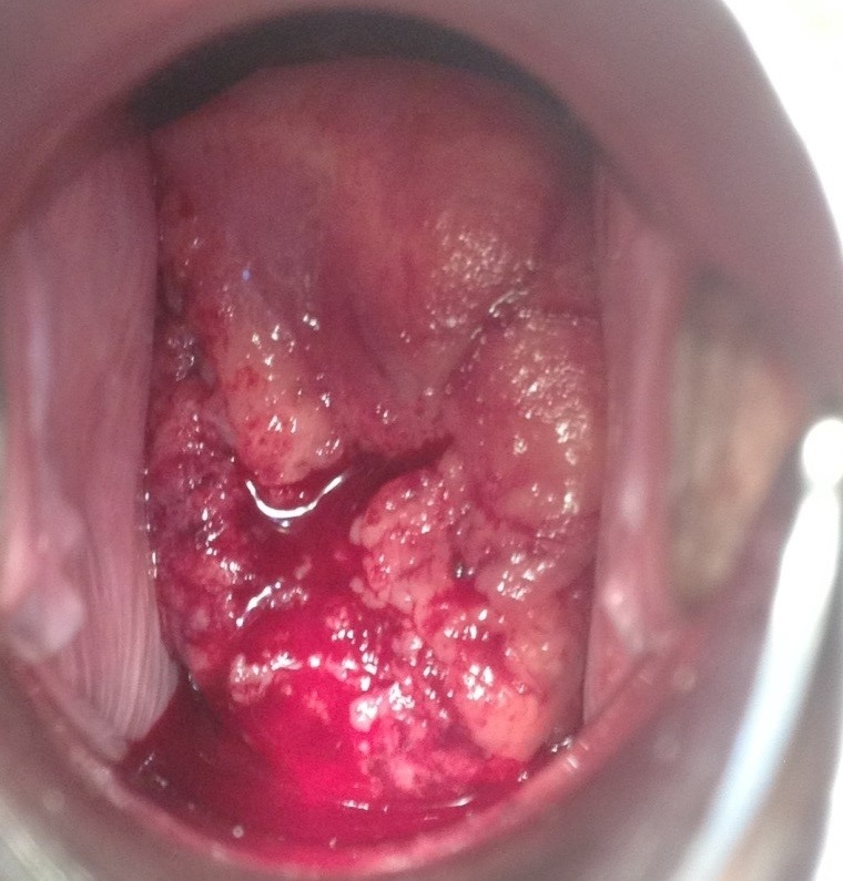 Опухоль шейки матки