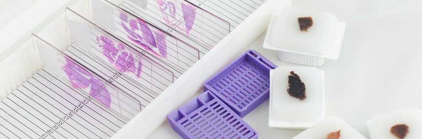 Опухоли слюнных желез