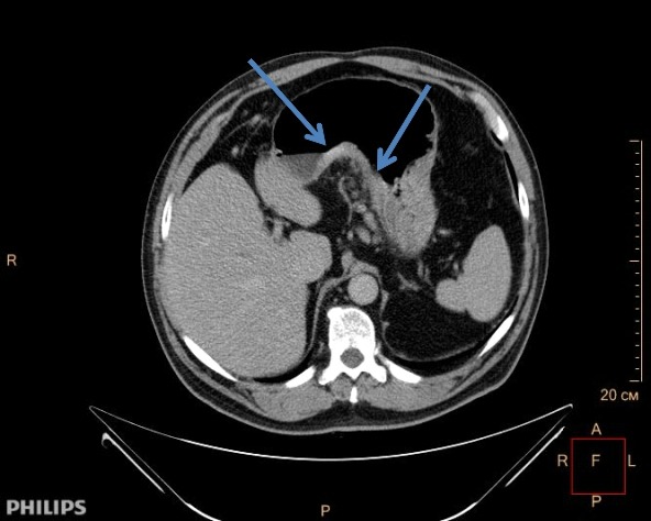 Как выглядит рак желудка