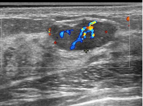 Рис.9 Эхограмма гиперваскулярной фиброаденомы молочной железы