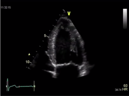 Измерение ФВ ЛЖ в 2D режиме по Simpson