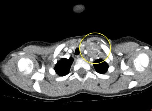 Поражение внутригрудных лимфатических узлов