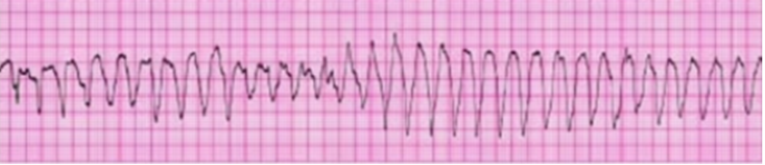 устойчивая желудочковая тахикардия