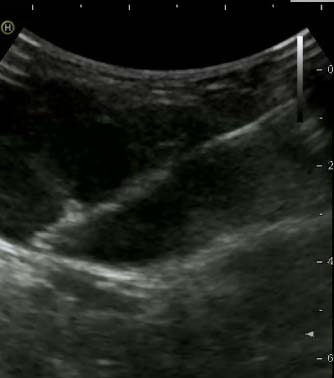 Трепан-биопсия