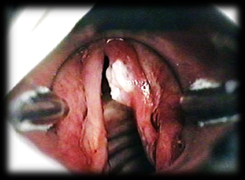 Лейкоплакия