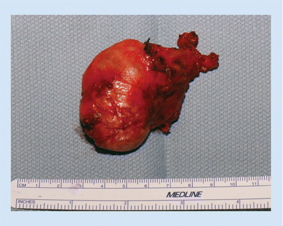 удаление паращитовидных желёз удаление паращитовидных желёз