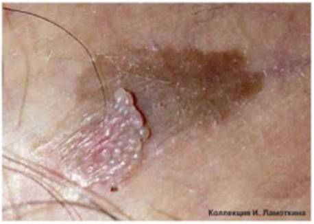 папулез бовеноидный