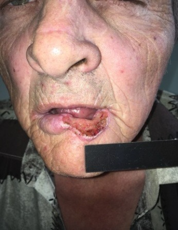 злокачественное новообразование