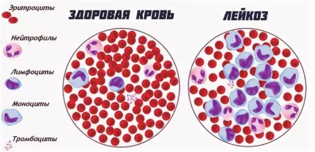 Острый лейкоз Острый лейкоз