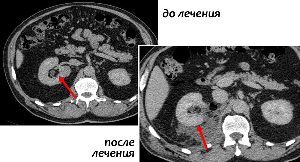 Хирургическое лечение