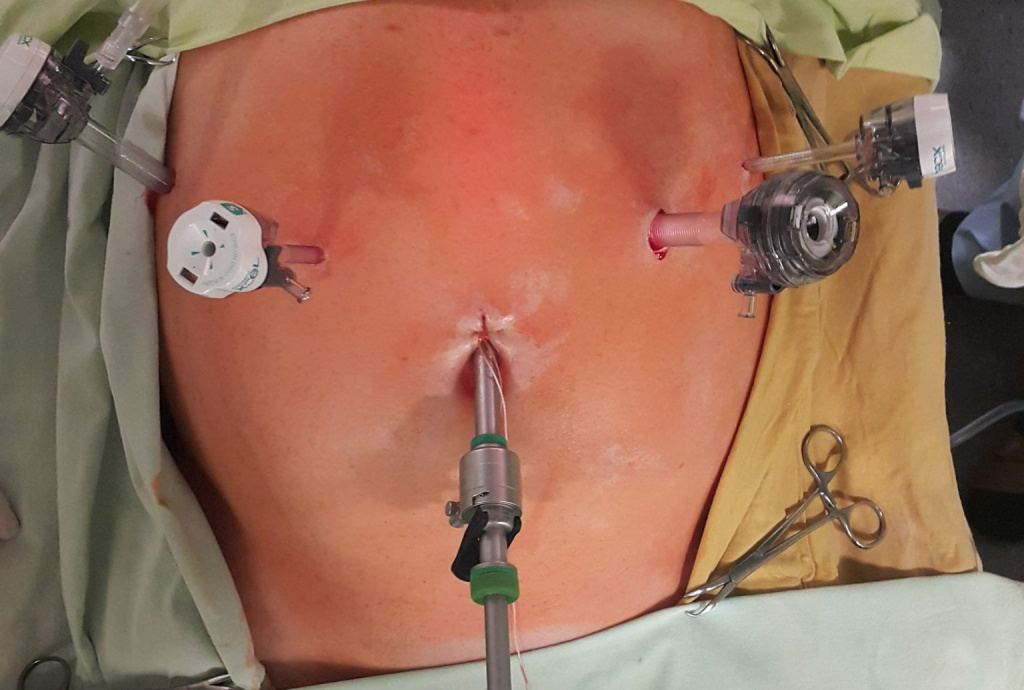 Виды рака желудка