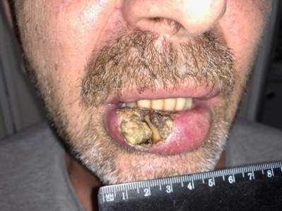 злокачественное новообразование