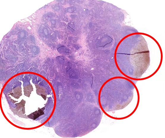метастазы в регионарных лимфатических узлах