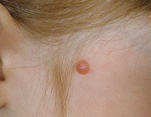 Шпиц–невус