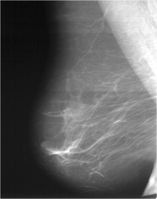 Эффект неоадъювантного лечения