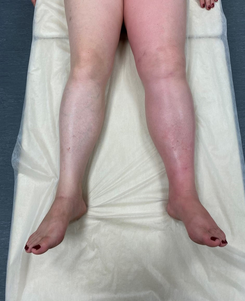 Лимфедема в течение 4 месяцев Лимфедема в течение 4 месяцев