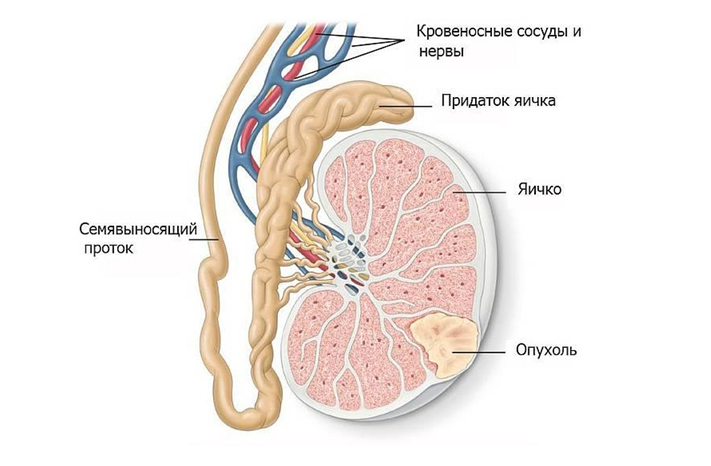 Опухоль в яичке Опухоль в яичке