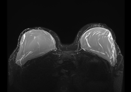Рис.14 МР-томограмма имплантов молочной железы