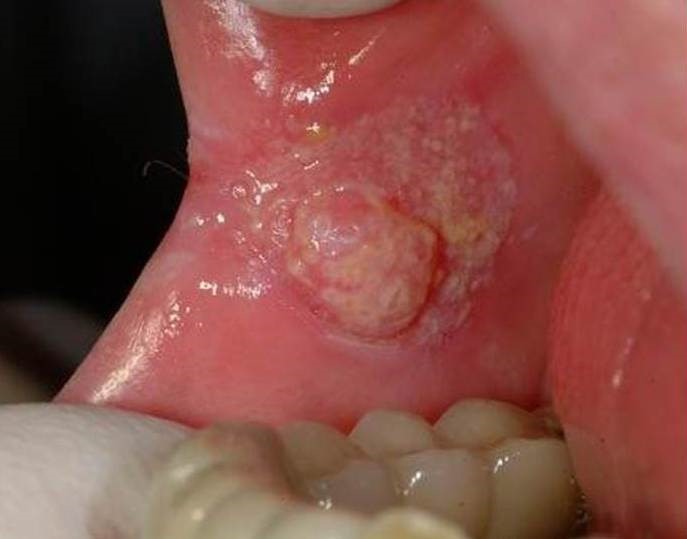 Рак полости рта