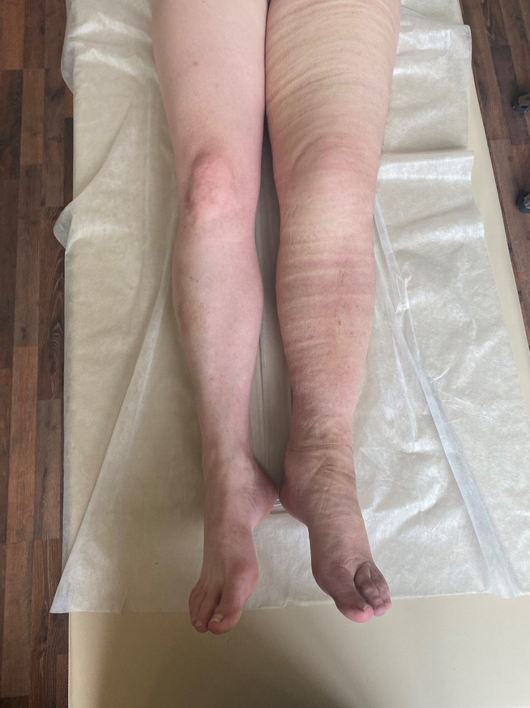 Лимфедема лечение Лимфедема лечение