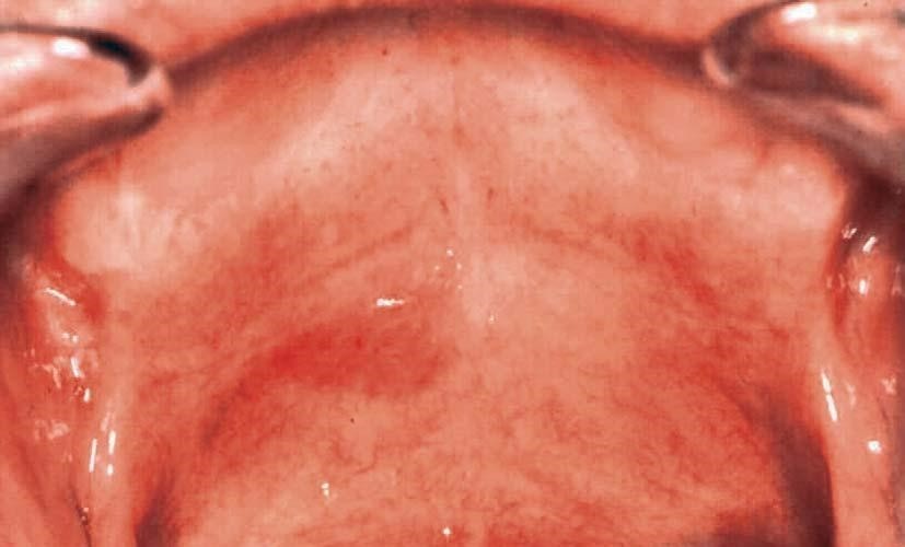 Эритроплакия