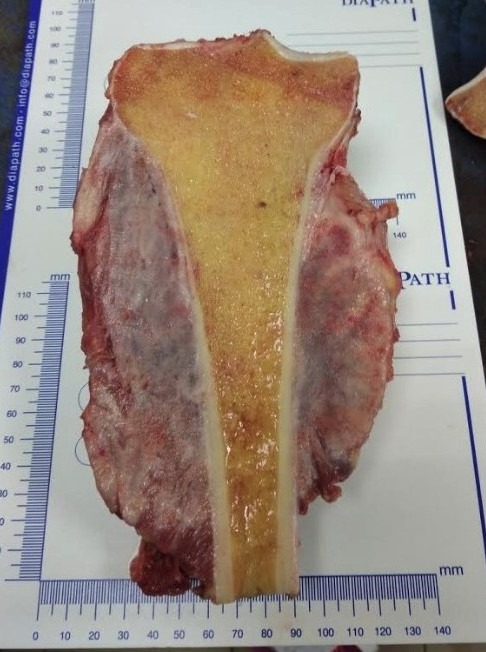 Остеогенная саркома