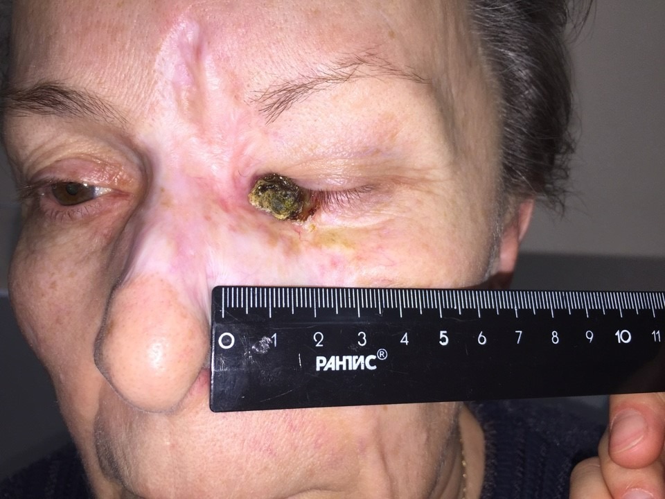 Базальноклеточный рак кожи