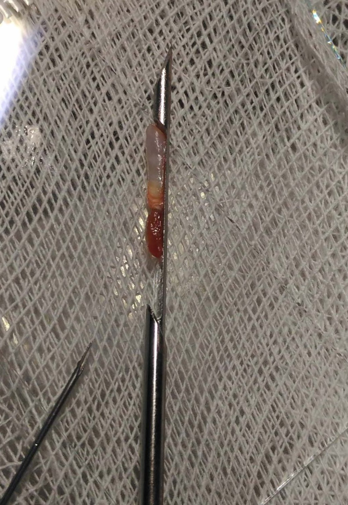 Материал биопсии