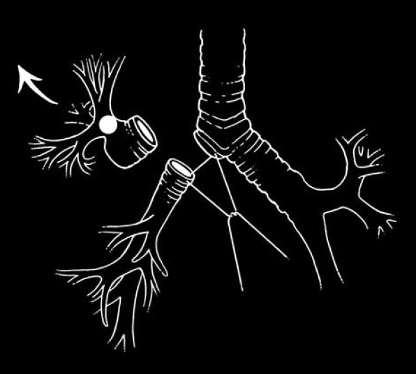 Схема лобэктомии