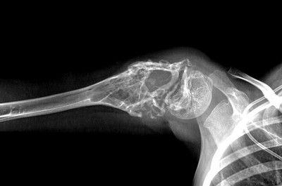 Саркома Юинга плечевой кости Саркома Юинга плечевой кости