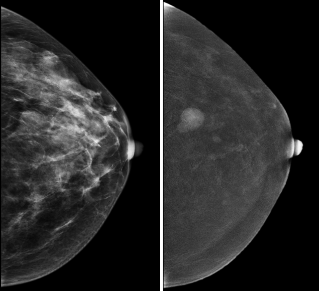 Рис.4 Маммограмма с контрастом: фиброаденома молочной железы