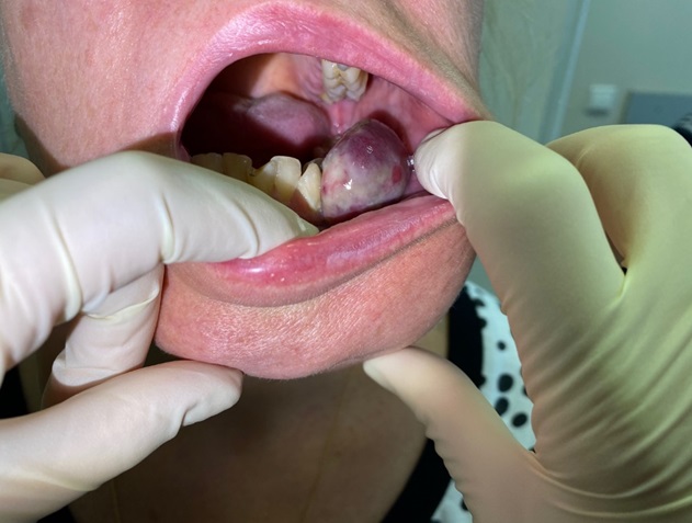 Остеогенная саркома нижней челюсти Остеогенная саркома нижней челюсти