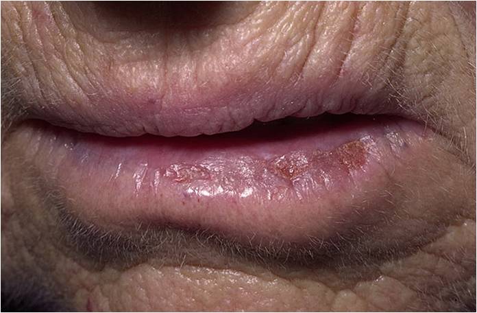 актинический хейлит