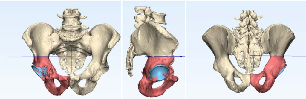 3D-моделирование операции