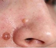 Дермальный невус