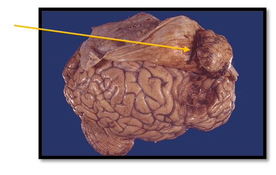 Менингиома Менингиома