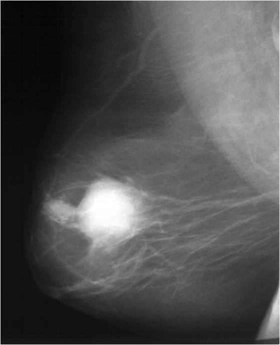 Эффект неоадъювантного лечения