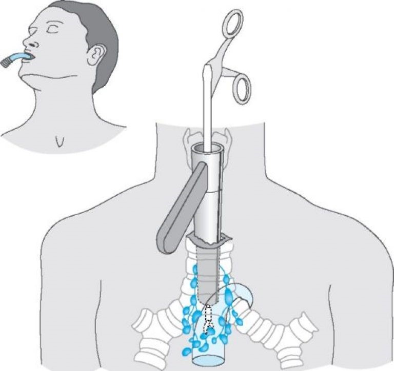 Хирургическое вмешательство Хирургическое вмешательство
