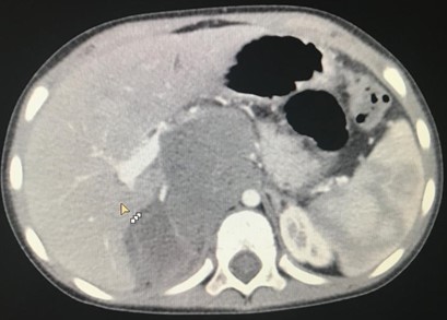 Рис. 5. КТ нейрогенного образования забрюшинного пространства справа