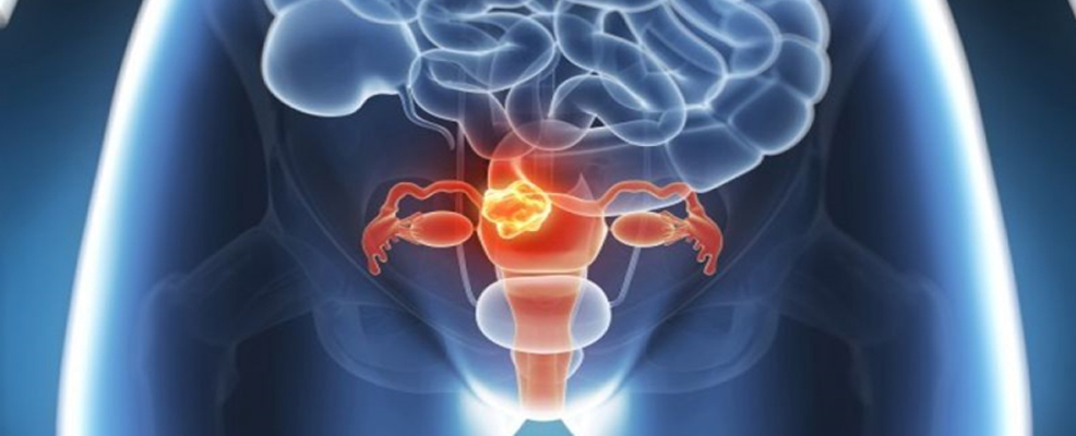 Саркома матки Саркома матки